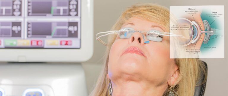 LipiFlow® Thermal Pulsation System: A New Dry Eye Treatment for MGD