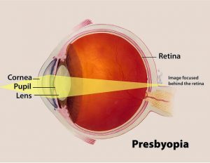 Light refracting on retina during presbyopia